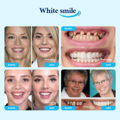 Alternative view of WHITESMILE™ – Fațetă Dentară Cosmetică Reglabilă