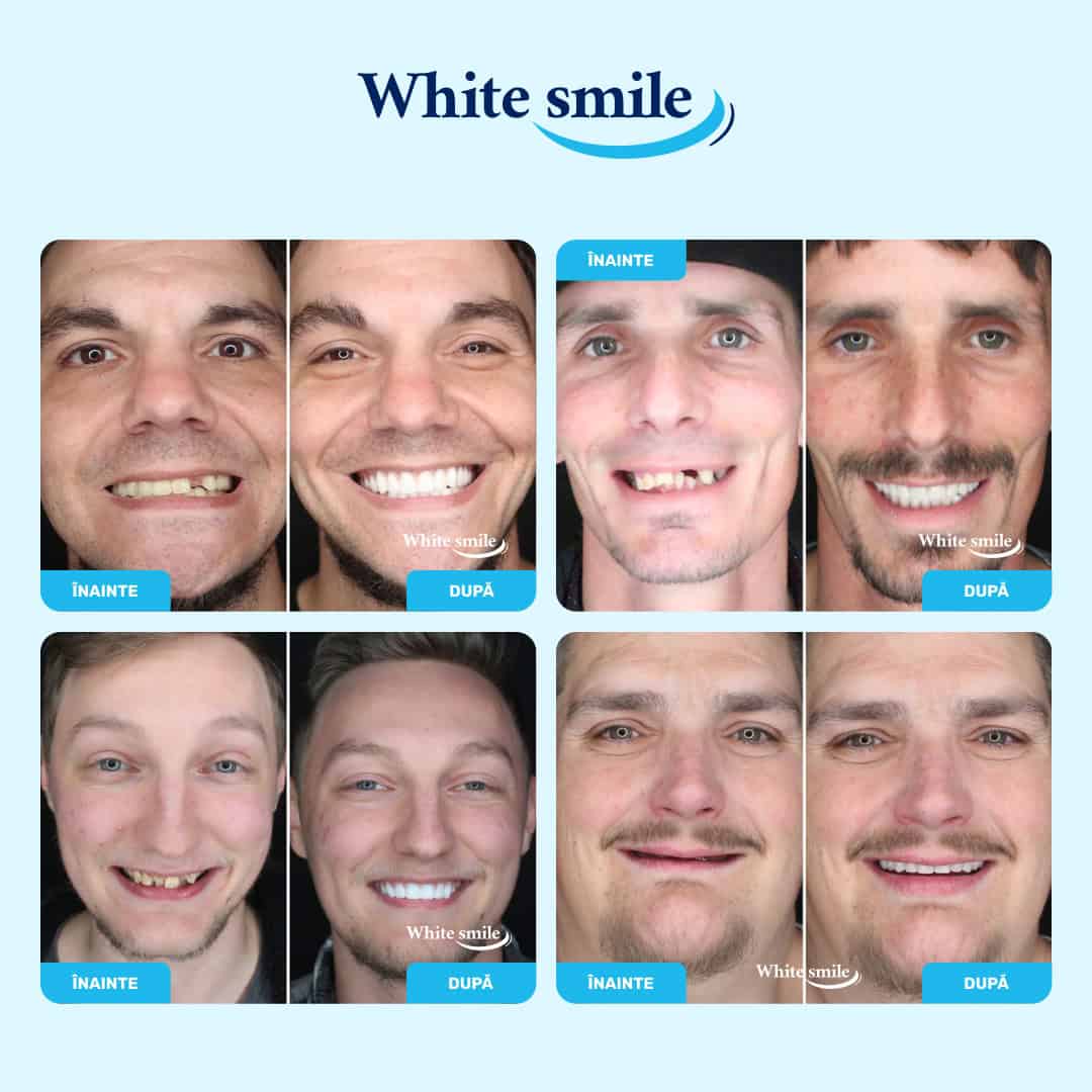 WHITESMILE™ – Fațetă Dentară Cosmetică Reglabilă - imagine 3