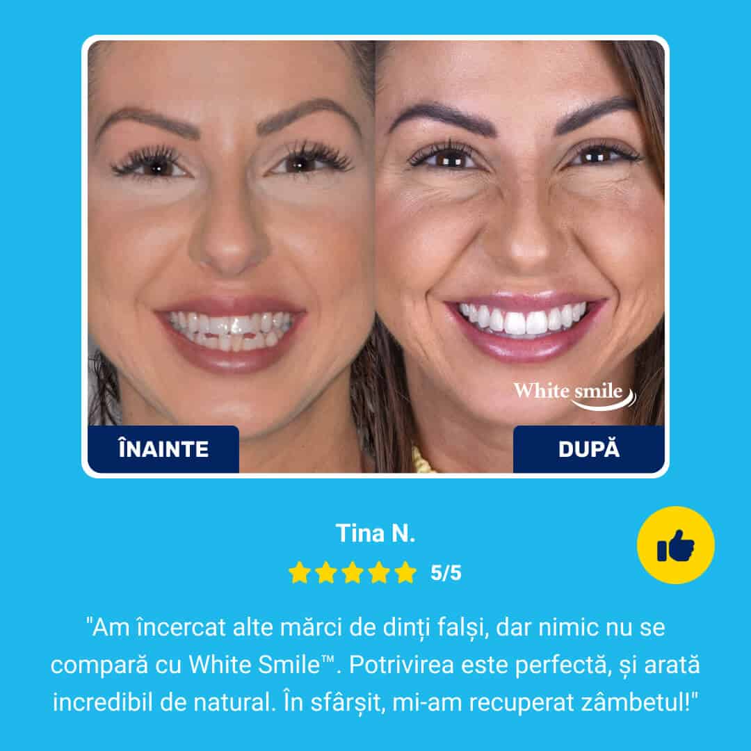 WHITESMILE™ – Fațetă Dentară Cosmetică Reglabilă - imagine 7