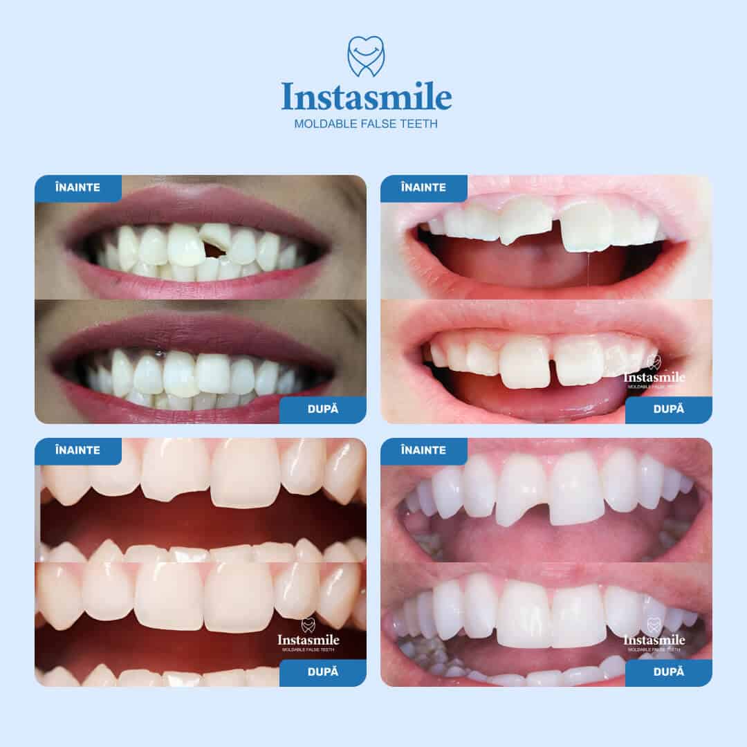 INSTASMILE – restaurare rapidă a zâmbetului pentru dinți rupți, lipsă sau cu spații - imagine 2