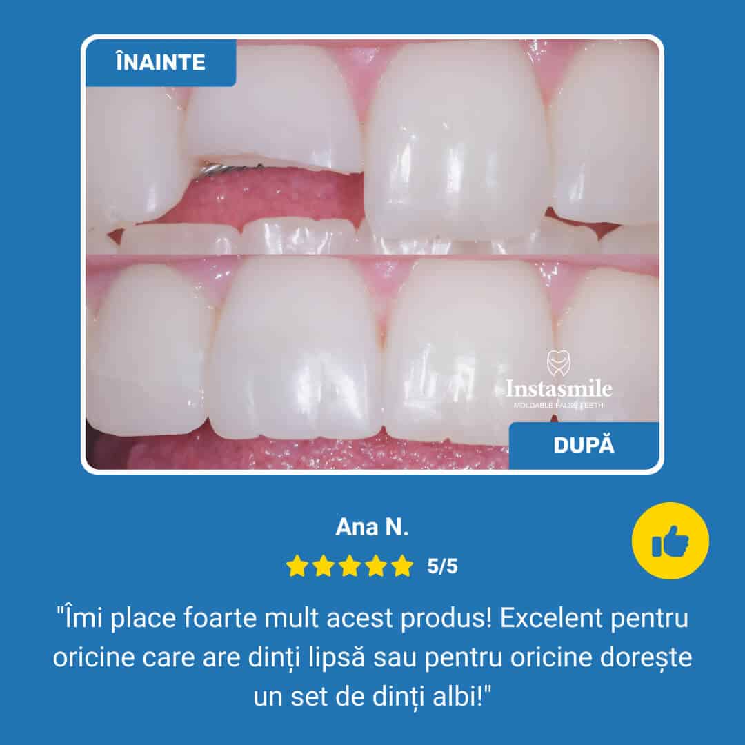 INSTASMILE – restaurare rapidă a zâmbetului pentru dinți rupți, lipsă sau cu spații - imagine 7
